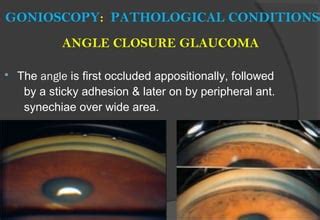 GONIOSCOPY | PPT