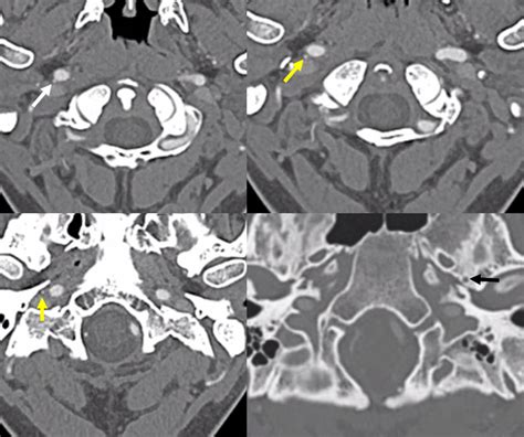 Middle Meningeal Artery | neuroangio.org