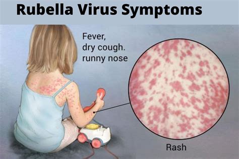 Rubella Virus Symptoms Treatment Causes in Hindi What is Rubella Virus ...