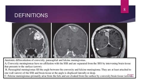 Meningioma falcine and parasagittal