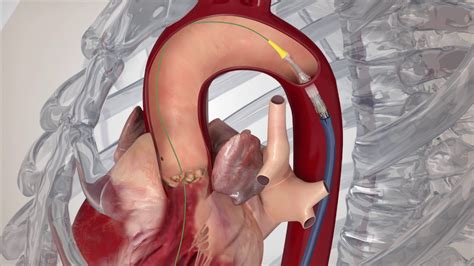 Edwards SAPIEN 3 Transfemoral Procedure Animation - YouTube