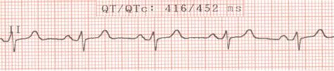 Electrocardiogram. Note: Normal QTc interval in men is | Download ...