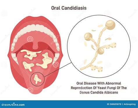 Oral Candidiasis. Oral Yeast Infection of Fungal Candida Albicans Stock ...