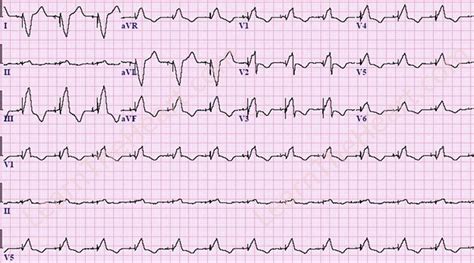 Biventricular Paced Rhythm ECG | LearntheHeart.com