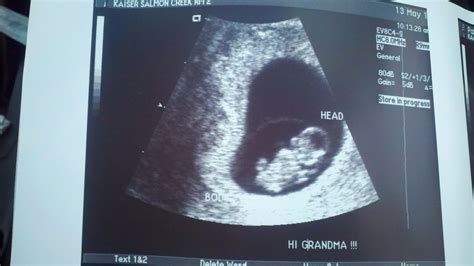 Parsons' Bebe: Ultrasound-8 Weeks