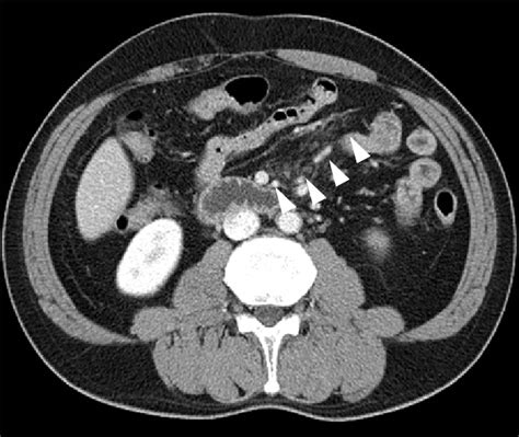 Normal Ct Scan Of Abdomen