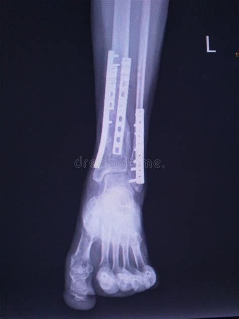 X-ray Ankle Joint AP Case Fracture Distal Metaphysis of Distal Tibia ...