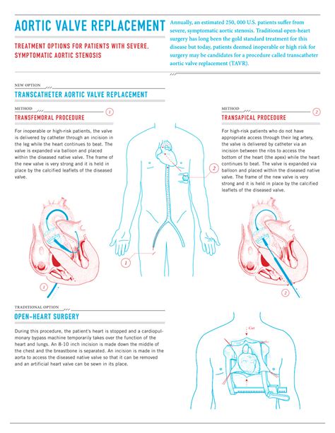 - Infographic: Aortic Valve Replacement - Column Five