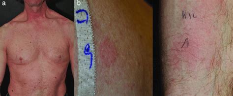 Case 3. (a) Erythematous macular rash on the trunk with sparing of the ...