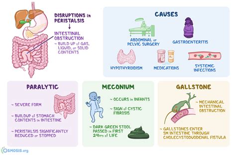 Ileus Adalah Penyakit - Homecare24