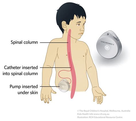 Baclofen Pump - Good? Bad? Not Sure?