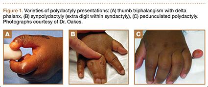 Polydactyly of the Hand | MDedge Surgery