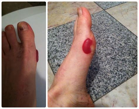 Runner's Feet 101: Prevention & Care of Black Toenails, Blisters ...