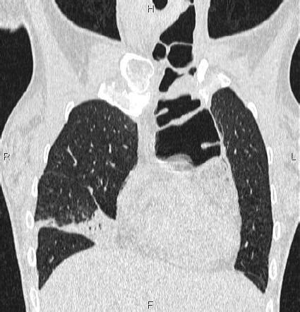 Esophagogastrectomy and colonic interposition | Radiology Case ...