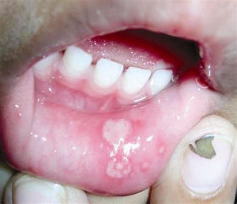 Coxsackie virus exanthem (hand-foot-mouth disease) | Medical Laboratories