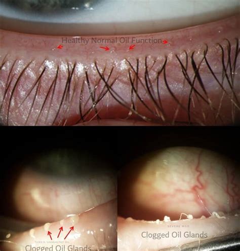 What is Meibomian Gland Dysfunction?