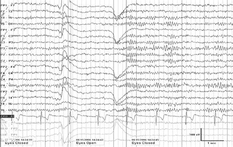 Normal Eeg Tracing