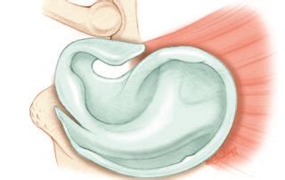 Postauricular Meatoplasty – Oto Surgery Atlas