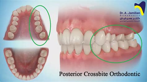 Posterior Crossbite