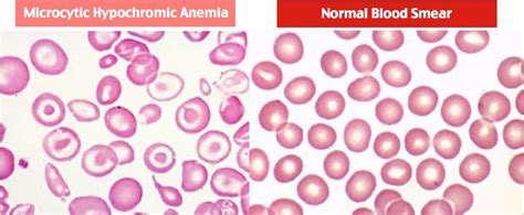 Pin on Hematology