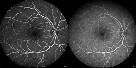 Fluorescein angiography showed normal findings in the right eye one ...