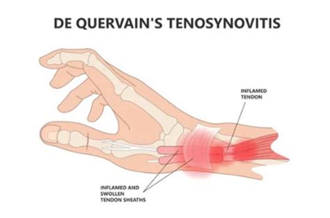 DE QUERVAIN TENOSYNOVITIS SURGERY - Midwest Orthopaedics