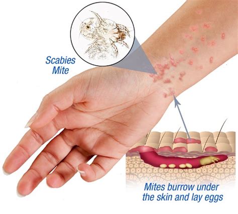 How Do You Get Scabies?