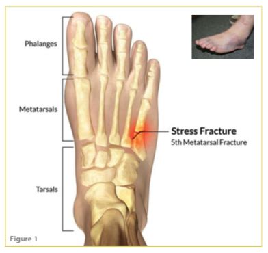 Metatarsal Bone Fracture