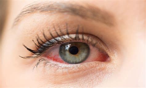 What Red Eyes Tell You About Your Health: Wolchok Eye Associates, PA ...