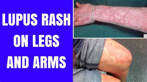 Lupus Rash On Legs Images