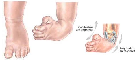 Congenital Talipes Equinovarus (Clubfoot) Nursing Care Management ...