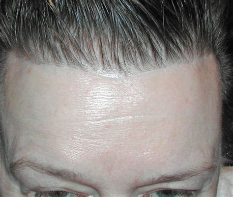 Pretrichial Browlift with Forehead reduction scar Dr Barry Eppley ...