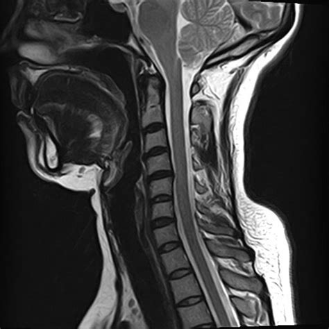 Abnormal Cervical Spine Mri