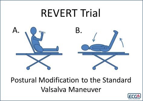 Modified Valsalva Maneuver for SVT - The Emergency Medical Minute