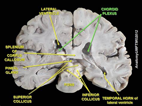 Slide2ff - Choroid plexus - Wikipedia, the free encyclopedia