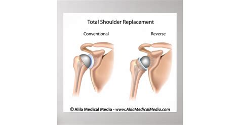 Conventional vs reverse total shoulder replacement poster | Zazzle