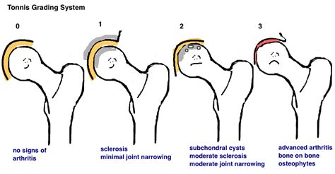 Hip Osteoarthritis — Hip & Knee Book