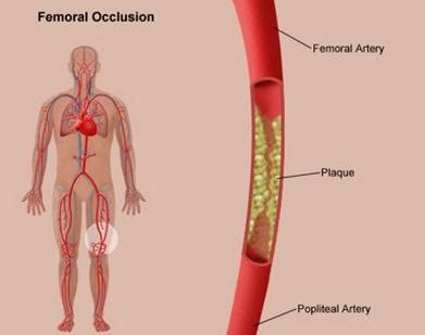 Intermittent Claudication