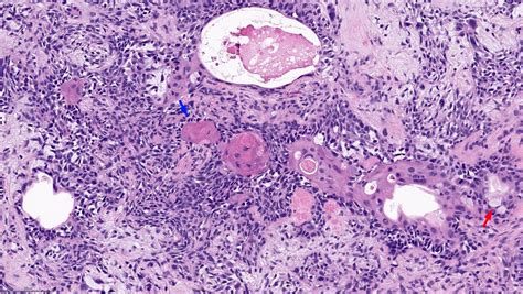 Pleomorphic Adenoma Pathology