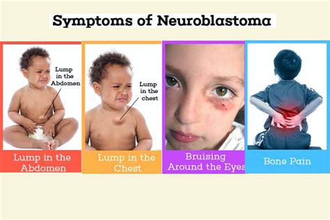 Neuroblastoma in Children: Stages, Symptoms, Causes, Treatment