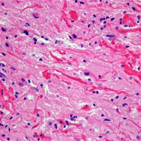 Pilocytic Astrocytoma - Oncology - Medbullets Step 2/3