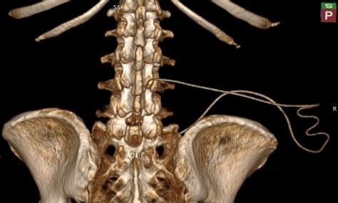 Lumboperitoneal shunt | Image | Radiopaedia.org