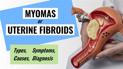 Uterine Fibroids (Myomas): Types, Causes, Symptoms, Diagnosis | SurgMedia