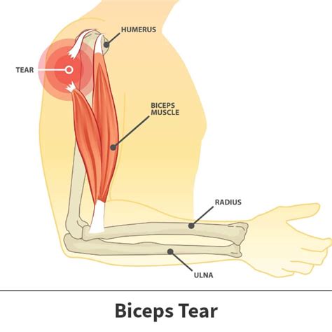 Bicep Tenodesis Information | Florida Orthopaedic Institute