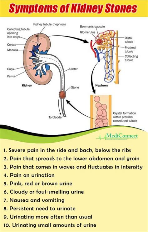 Signs and Symptoms of Kidney Stones | Kidney Transplant in India ...