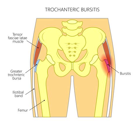 Trochanteric Bursitis: A Helpful Introduction & Overview | Dr ...