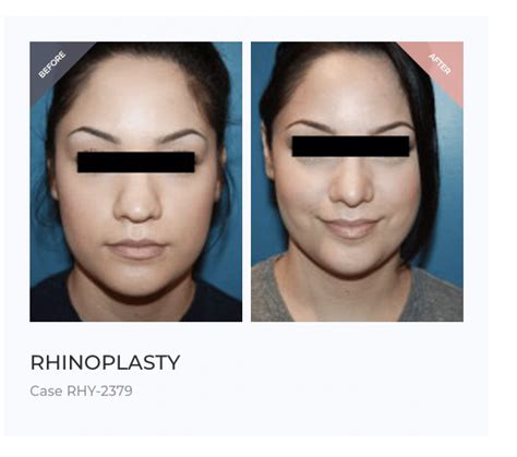 The Guide to Bulbous Nose Rhinoplasty | Wide Nasal Tip Surgery