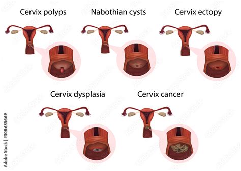 Cervical diseases. Cervix polyps, ectopy, dysplasia, cancer, nabothian ...