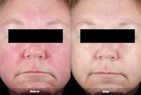 Rosacea Treatment Photos | Rosacea.org