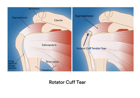 Supraspinatus Muscle Tear